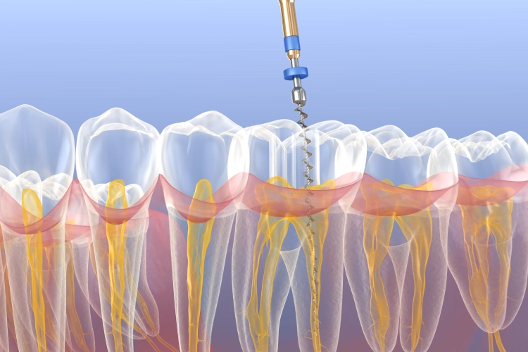 Dentist performing root canal therapy in Surrey
